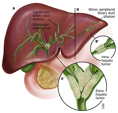 Hepatobilliary Cancers