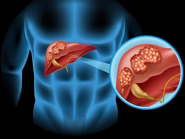 Hepatobiliary Cancers